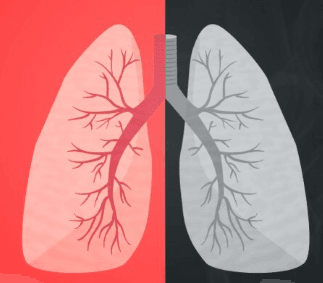 Akciğer Kanseri Görseli